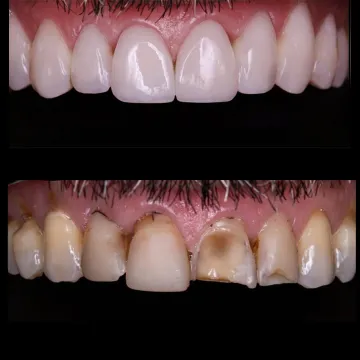 نمونه کار کامپوزیت