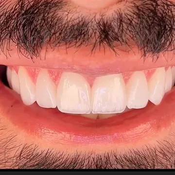 نمونه کار کامپوزیت