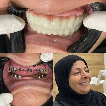 نمونه کار ایمپلنت